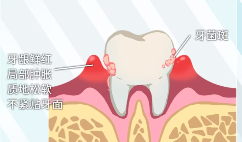 牙龈炎发病机制