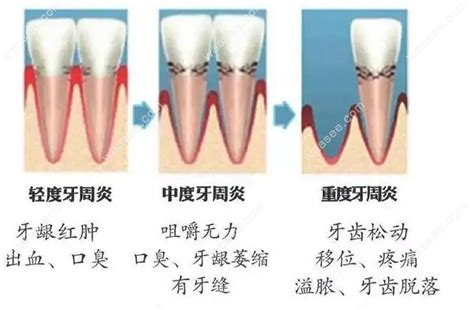 白内障发病机制