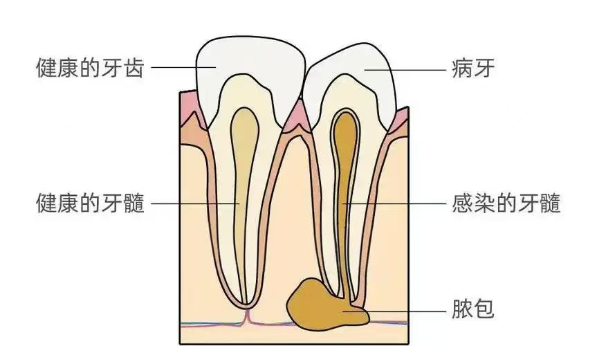 正常牙髓与牙髓炎对比