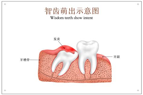 智齿萌出示意图